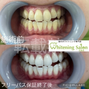 【歯周病予防】