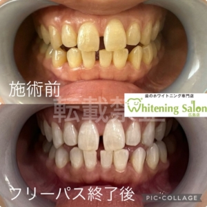 【酸蝕歯について】