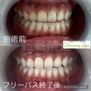 【ホワイトニングは当店へお任せください🎀】