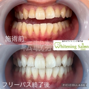 【歯の定期検診】