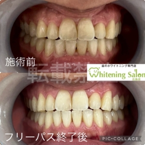 【酸蝕症の予防法💡】
