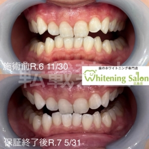 【ホームホワイトニングと根元の色上がり】