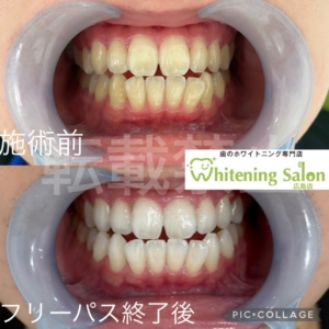 【歯間ブラシの臭い🤧】