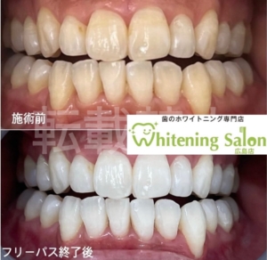 【当店のホワイトニングケアシステム✓】
