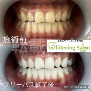 【歯のむずむず感🤧】