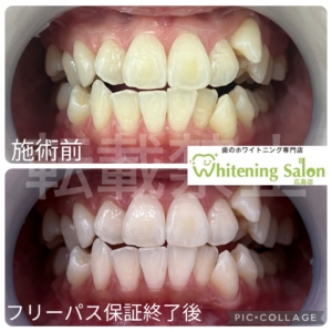 【歯がかけたり折れたら？🤔】