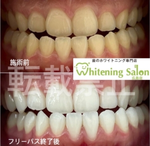 【歯間ブラシの頻度】