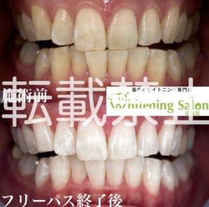 【男性もホワイトニング🎶】