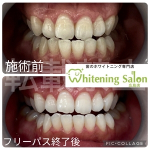 【歯のギザギザ】