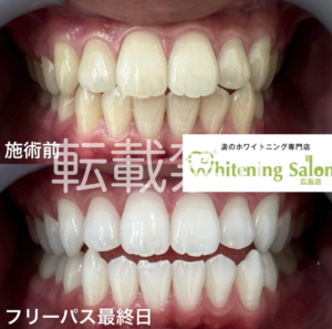 【ホワイトニングの重要さ✨】