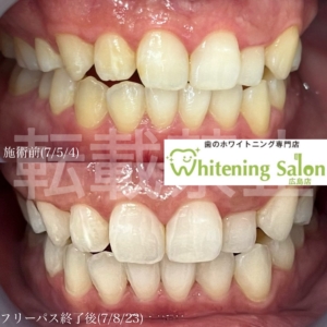 【エナメル質が薄いと】
