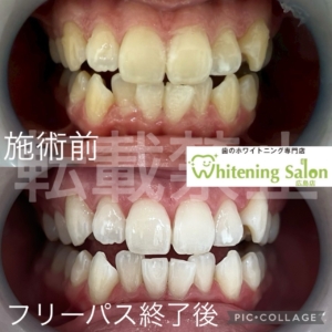 【男性もホワイトニング😄】