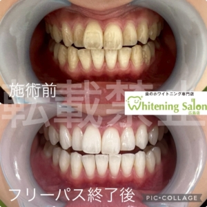 【歯を強くする栄養素】