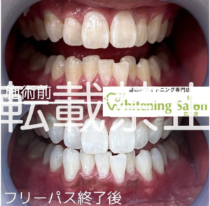 【虫歯について😣】