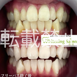 【ホワイトニングと矯正💡】