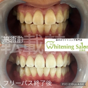 【エナジードリンクと歯】