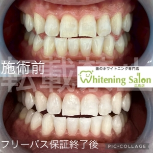 【ストレスが虫歯を引き起こす？！】