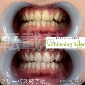 【歯石は何歳から？】