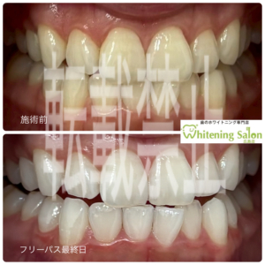 【綺麗な白い歯を維持しましょう✨️】広島/ホワイトニング