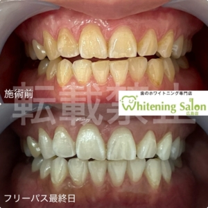 【歯が白いといいこと🌙】