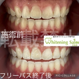 【歯茎の痛痒さ】広島/ホワイトニング
