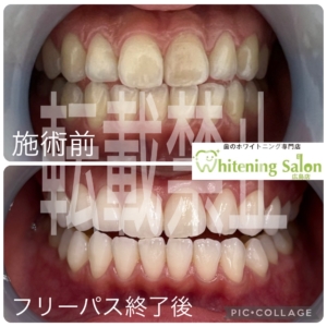 【目安のホワイトニング照射回数お伝えします★】