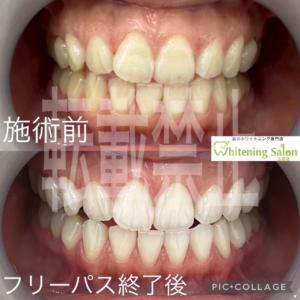 【ホワイトニングの色戻り💧‬】
