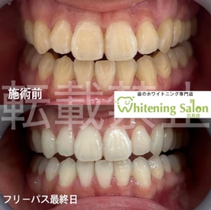 【歯のザラつきを放置するとどうなる？】広島/ホワイトニング