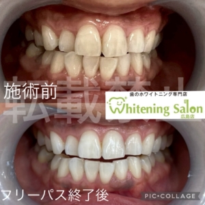 【ホワイトスポットについて】広島/ホワイトニング