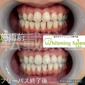 【歯石を放置すると】広島/ホワイトニング