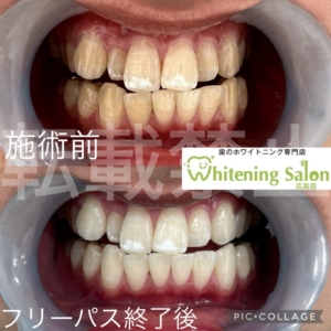 【11/11はポッキーの日🍫】広島/ホワイトニング