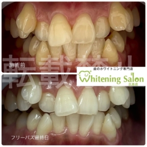 【ケーキと虫歯🎅🏻🍰】広島/ホワイトニング