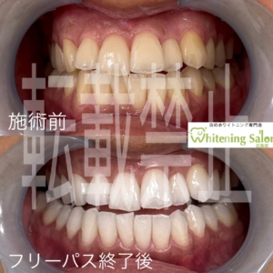 【メンテナンスは大切🎵✨】広島/ホワイトニング