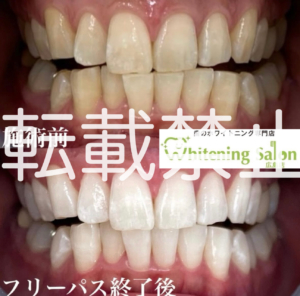 【初めてのホワイトニング🎀】広島/ホワイトニング