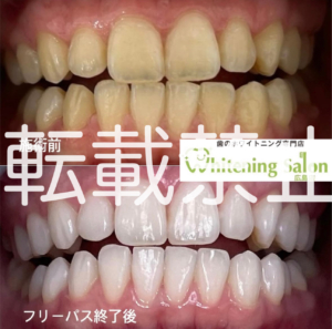 【集中コース🌙】広島/ホワイトニング