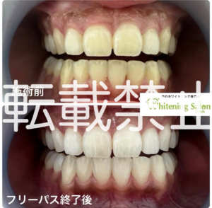 【ワインについて🍷】広島/ホワイトニング