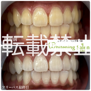 【舌を噛む理由😖】広島/ホワイトニング