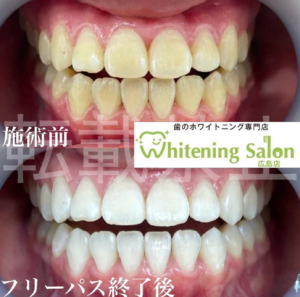 【歯の天敵😈】広島/ホワイトニング