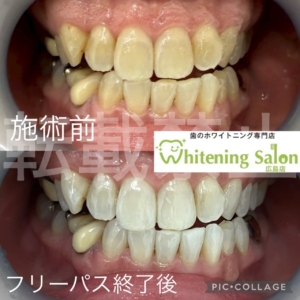 【神経のない歯】広島/ホワイトニング