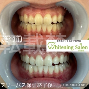 【実は怖い虫歯】広島/ホワイトニング