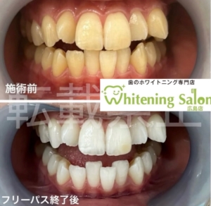 【下がった歯茎は元に戻る？】広島/ホワイトニング
