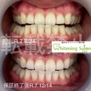 【歯の茶渋について】広島/ホワイトニング