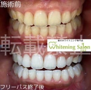 【強い歯の作り方】広島/ホワイトニング