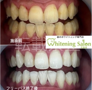 【自分にあった通い方で💖】広島/ホワイトニング