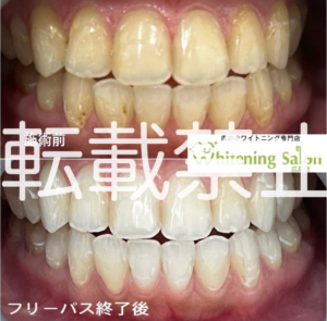 【流行のホワイトニング🎶】広島/ホワイトニング
