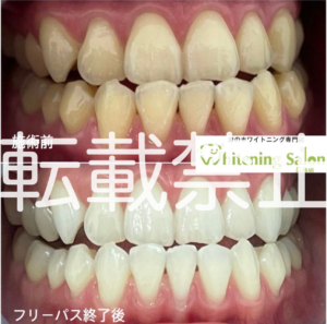 【フロスについて⭐️】広島/ホワイトニング