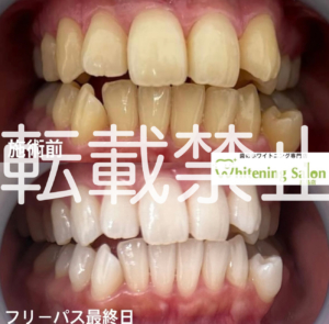 【Xmasまでに🎅】広島/ホワイトニング