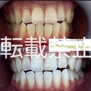 【今年中に汚れを✨】広島/ホワイトニング