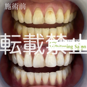 【うがいについて🦷】広島/ホワイトニング