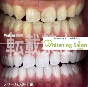 【歯ブラシの選び方】広島/ホワイトニング